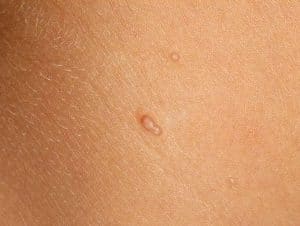 Molluscum contagiosum