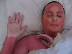 Peau rouge