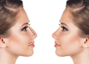 rhinoplastie Lyon