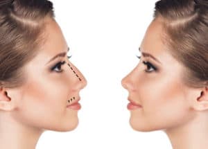 rhinoplastie Lyon