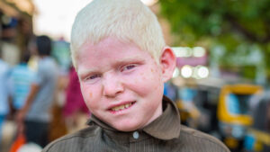L'albinisme