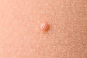 Nodule